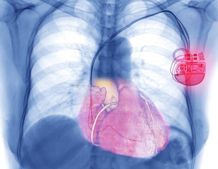 Permanent Pacemaker Implantation Dr Aditya Dhawale